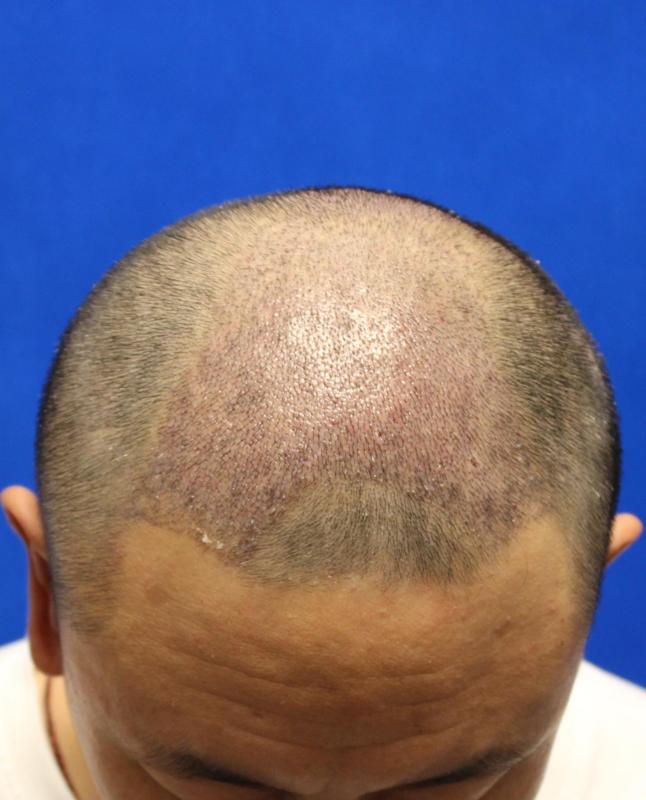 年輕的地中海植發,如何完成自身的升華,找回青春的自信